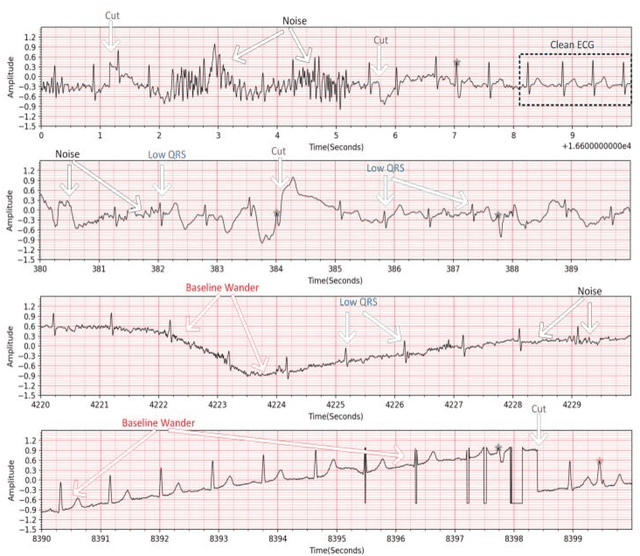 Figure 1 for Blind ECG Restoration by Operational Cycle-GANs