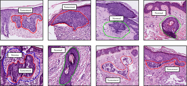 Figure 1 for Deeply supervised UNet for semantic segmentation to assist dermatopathological assessment of Basal Cell Carcinoma (BCC)