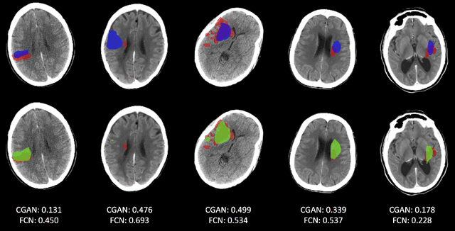 Figure 4 for CT-To-MR Conditional Generative Adversarial Networks for Ischemic Stroke Lesion Segmentation