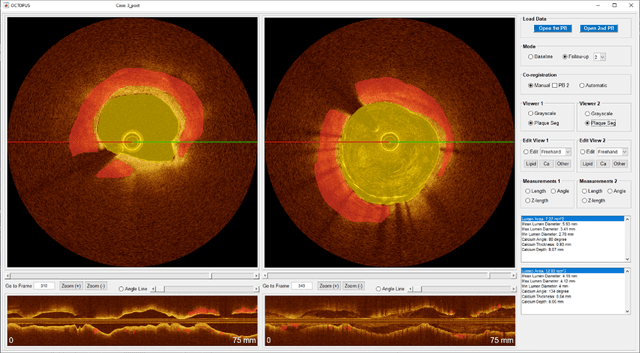 Figure 3 for OCTOPUS -- optical coherence tomography plaque and stent analysis software