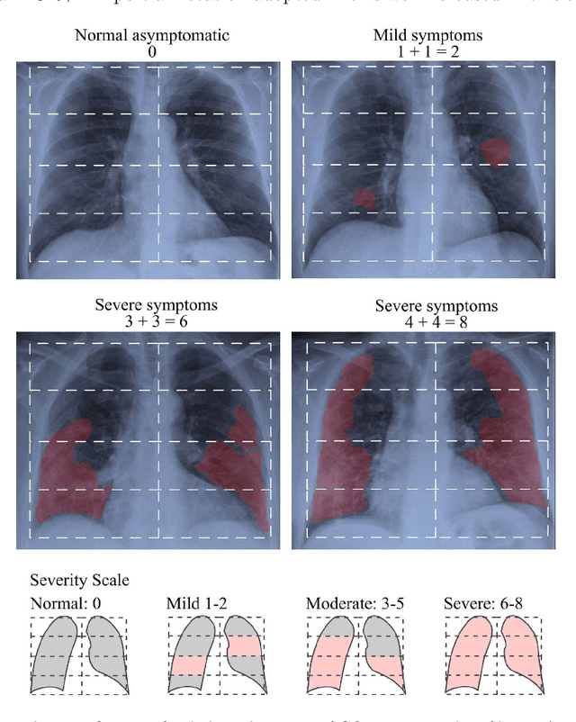 Figure 1 for COVIDGR dataset and COVID-SDNet methodology for predicting COVID-19 based on Chest X-Ray images
