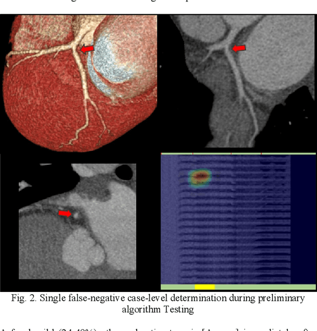 Figure 2 for Artificial Intelligence to Assist in Exclusion of Coronary Atherosclerosis during CCTA Evaluation of Chest-Pain in the Emergency Department: Preparing an Application for Real-World Use