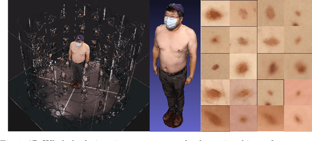Figure 2 for Monitoring of Pigmented Skin Lesions Using 3D Whole Body Imaging
