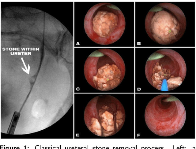 Figure 2 for On the in vivo recognition of kidney stones using machine learning