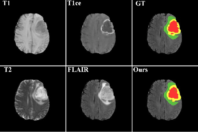 Figure 1 for CANet: Context Aware Network for 3D Brain Tumor Segmentation