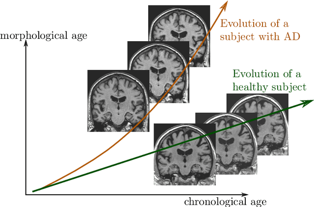 Figure 1 for A model of brain morphological changes related to aging and Alzheimer's disease from cross-sectional assessments