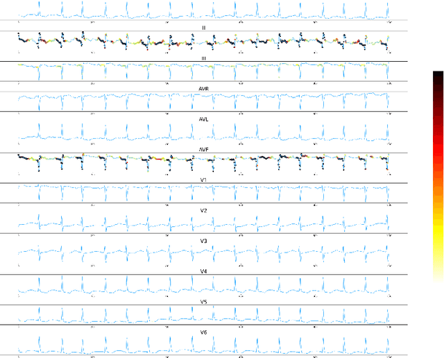 Figure 4 for IMLE-Net: An Interpretable Multi-level Multi-channel Model for ECG Classification
