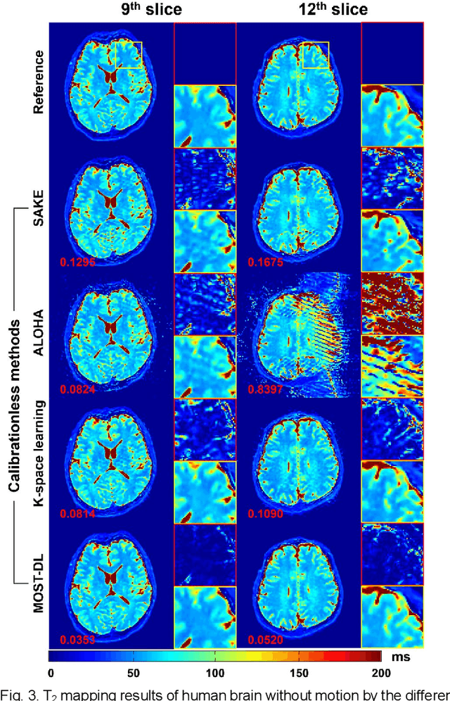 Figure 3 for Model-based Synthetic Data-driven Learning (MOST-DL): Application in Single-shot T2 Mapping with Severe Head Motion Using Overlapping-echo Acquisition