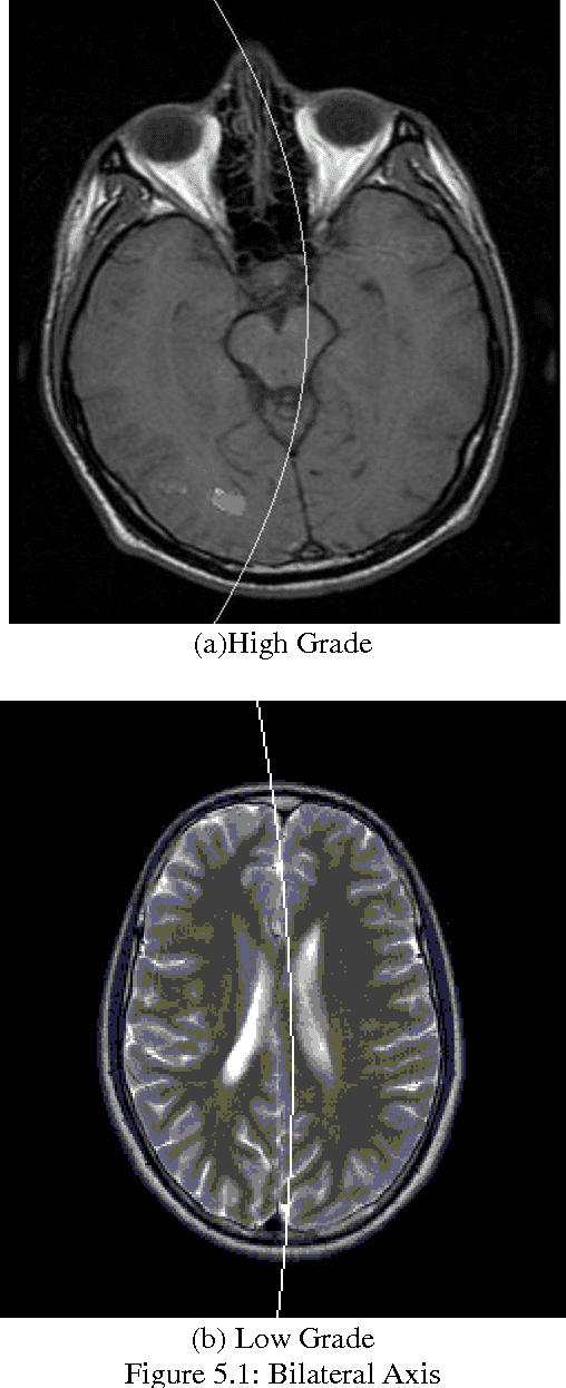 Figure 2 for Brain Tumor Detection Based On Mathematical Analysis and Symmetry Information