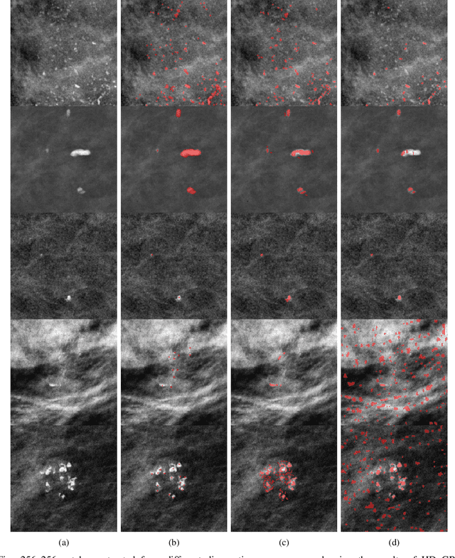 Figure 4 for Segmentation of Breast Microcalcifications: A Multi-Scale Approach