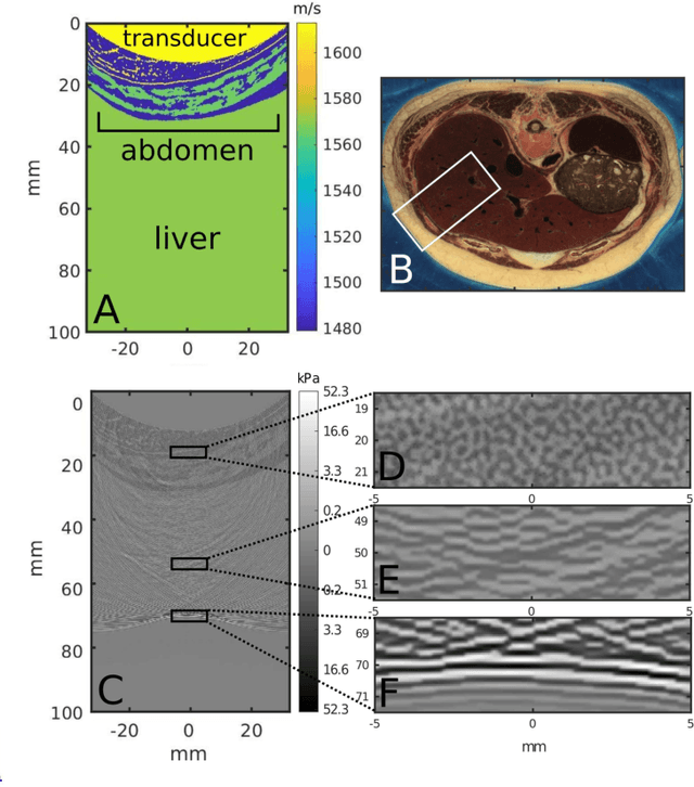 Figure 2 for Deconstruction and reconstruction of image-degrading effects in the human abdomen using Fullwave: phase aberration, multiple reverberation, and trailing reverberation