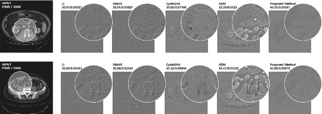 Figure 2 for Unsupervised CT Metal Artifact Learning using Attention-guided beta-CycleGAN