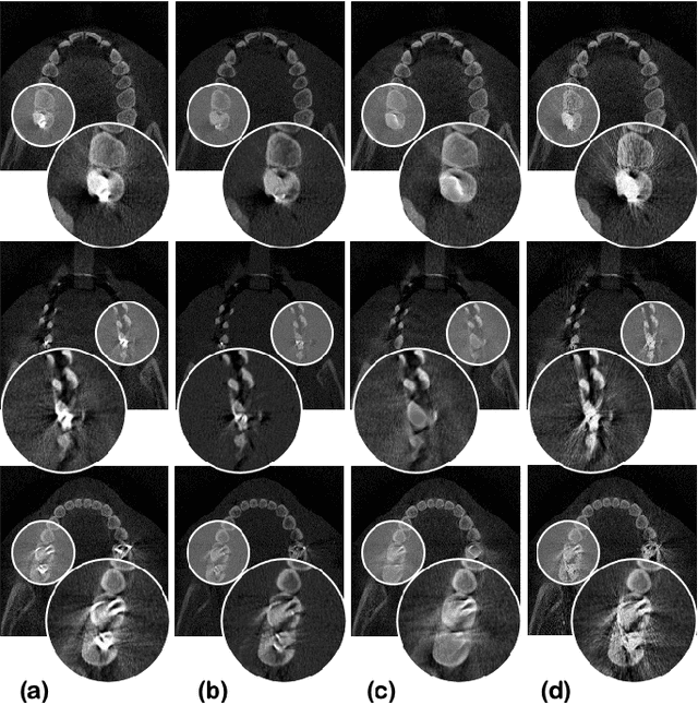 Figure 3 for Unsupervised CT Metal Artifact Learning using Attention-guided beta-CycleGAN