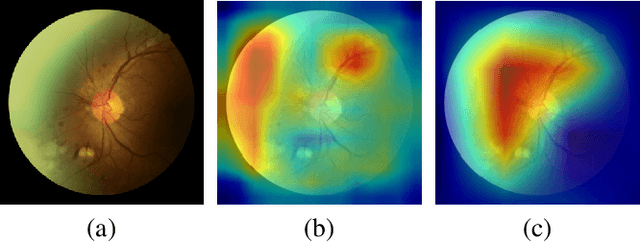 Figure 4 for Learning Discriminative Representations for Fine-Grained Diabetic Retinopathy Grading