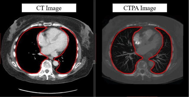 Figure 1 for Computerized Tomography Pulmonary Angiography Image Simulation using Cycle Generative Adversarial Network from Chest CT imaging in Pulmonary Embolism Patients