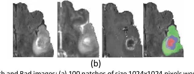 Figure 3 for Radiopathomics: Integration of radiographic and histologic characteristics for prognostication in glioblastoma