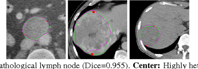 Figure 3 for A Fully-Automated Pipeline for Detection and Segmentation of Liver Lesions and Pathological Lymph Nodes