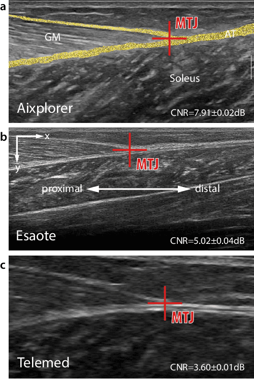 Figure 1 for A Human-Centered Machine-Learning Approach for Muscle-Tendon Junction Tracking in Ultrasound Images