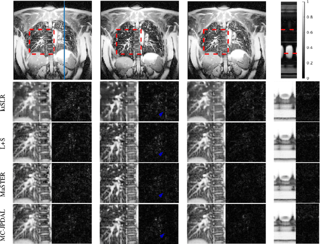 Figure 3 for Motion Compensated Dynamic MRI Reconstruction with Local Affine Optical Flow Estimation