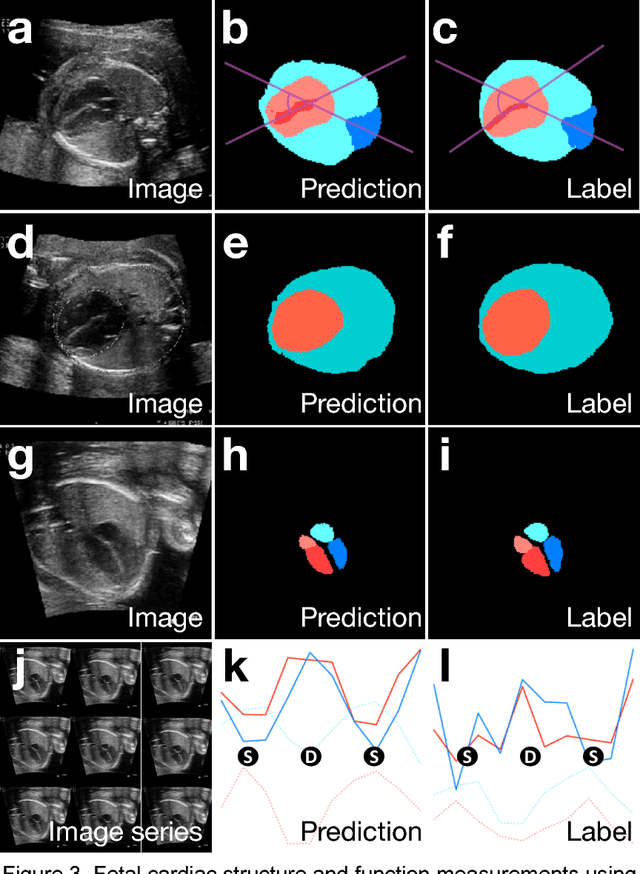 Figure 3 for Deep-learning models improve on community-level diagnosis for common congenital heart disease lesions