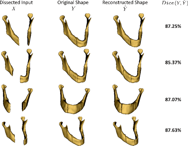 Figure 4 for Variational Mandible Shape Completion for Virtual Surgical Planning