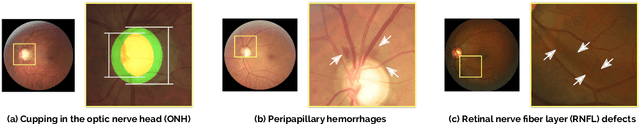 Figure 3 for REFUGE Challenge: A Unified Framework for Evaluating Automated Methods for Glaucoma Assessment from Fundus Photographs