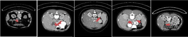 Figure 1 for Fully Automated Pancreas Segmentation with Two-stage 3D Convolutional Neural Networks