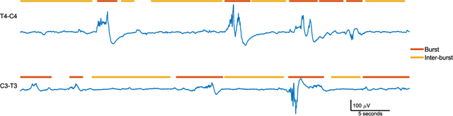 Figure 1 for Random Convolution Kernels with Multi-Scale Decomposition for Preterm EEG Inter-burst Detection