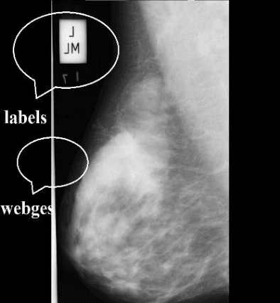 Figure 3 for Automatic elimination of the pectoral muscle in mammograms based on anatomical features