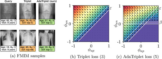 Figure 1 for AdaTriplet: Adaptive Gradient Triplet Loss with Automatic Margin Learning for Forensic Medical Image Matching