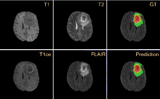 Figure 1 for Residual Channel Attention Network for Brain Glioma Segmentation