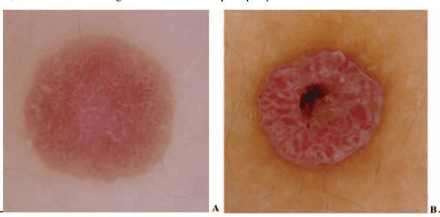 Figure 1 for Computer Aided Diagnosis for Spitzoid lesions classification using Artificial Intelligence techniques