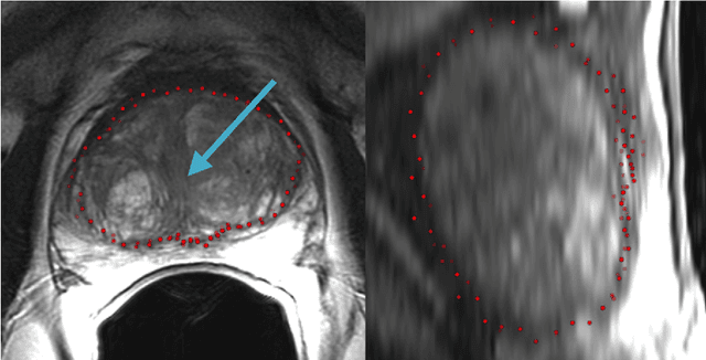 Figure 3 for PCG-Cut: Graph Driven Segmentation of the Prostate Central Gland