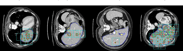 Figure 3 for Detection-aided liver lesion segmentation using deep learning