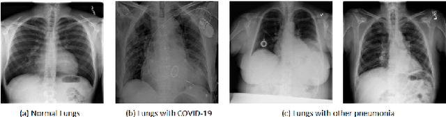 Figure 2 for Early-stage COVID-19 diagnosis in presence of limited posteroanterior chest X-ray images via novel Pinball-OCSVM