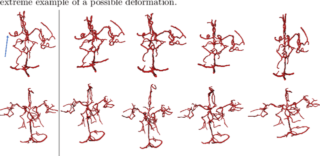 Figure 3 for Detection of Large Vessel Occlusions using Deep Learning by Deforming Vessel Tree Segmentations