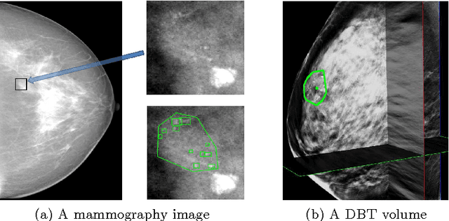 Figure 1 for Transferring Learned Microcalcification Group Detection from 2D Mammography to 3D Digital Breast Tomosynthesis Using a Hierarchical Model and Scope-based Normalization Features