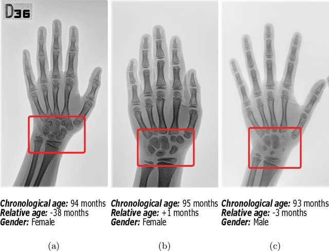 Figure 1 for SIMBA: Specific Identity Markers for Bone Age Assessment