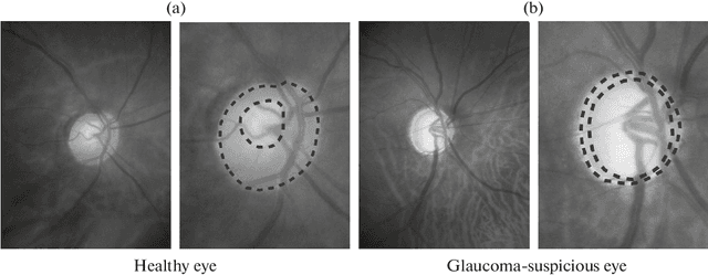 Figure 1 for Optic Disc and Cup Segmentation Methods for Glaucoma Detection with Modification of U-Net Convolutional Neural Network