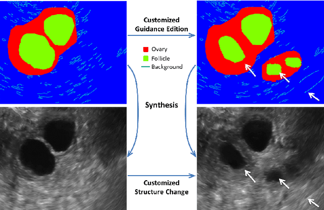 Figure 1 for Synthesis and Edition of Ultrasound Images via Sketch Guided Progressive Growing GANs