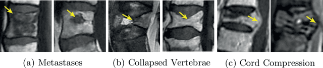 Figure 3 for Context-Aware Transformers For Spinal Cancer Detection and Radiological Grading