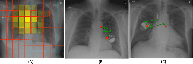 Figure 4 for Learning what to look in chest X-rays with a recurrent visual attention model