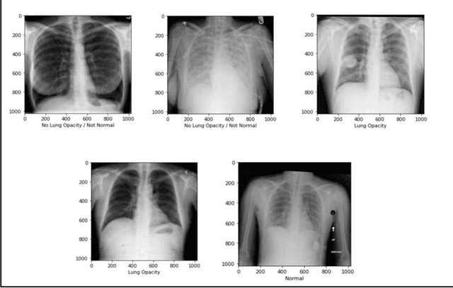 Figure 1 for Pneumonia Detection in Chest X-Rays using Neural Networks