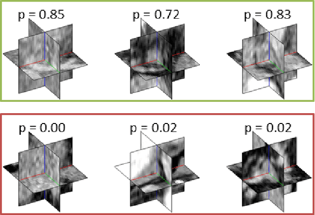 Figure 3 for Improving Computer-aided Detection using Convolutional Neural Networks and Random View Aggregation