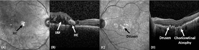 Figure 1 for Evaluation of Deep Segmentation Models for the Extraction of Retinal Lesions from Multi-modal Retinal Images