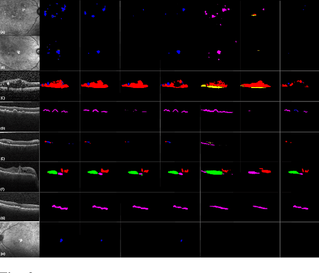 Figure 3 for Evaluation of Deep Segmentation Models for the Extraction of Retinal Lesions from Multi-modal Retinal Images