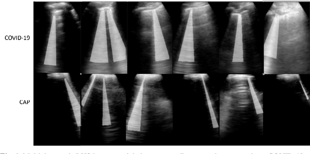 Figure 1 for Lung Ultrasound Segmentation and Adaptation between COVID-19 and Community-Acquired Pneumonia