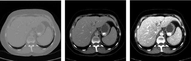 Figure 4 for Automatic Liver and Tumor Segmentation of CT and MRI Volumes using Cascaded Fully Convolutional Neural Networks