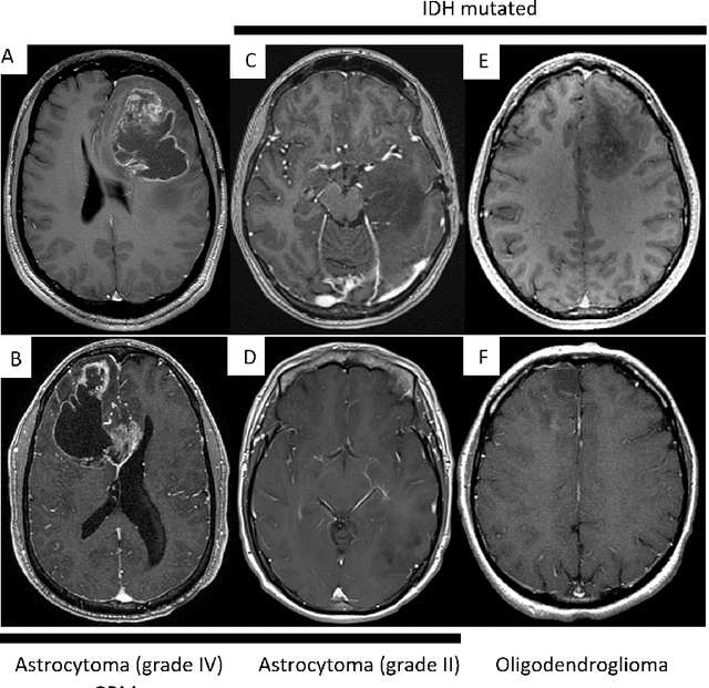 Figure 1 for Applying Artificial Intelligence to Glioma Imaging: Advances and Challenges