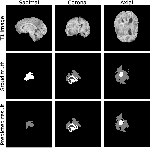 Figure 1 for Brain-wise Tumor Segmentation and Patient Overall Survival Prediction